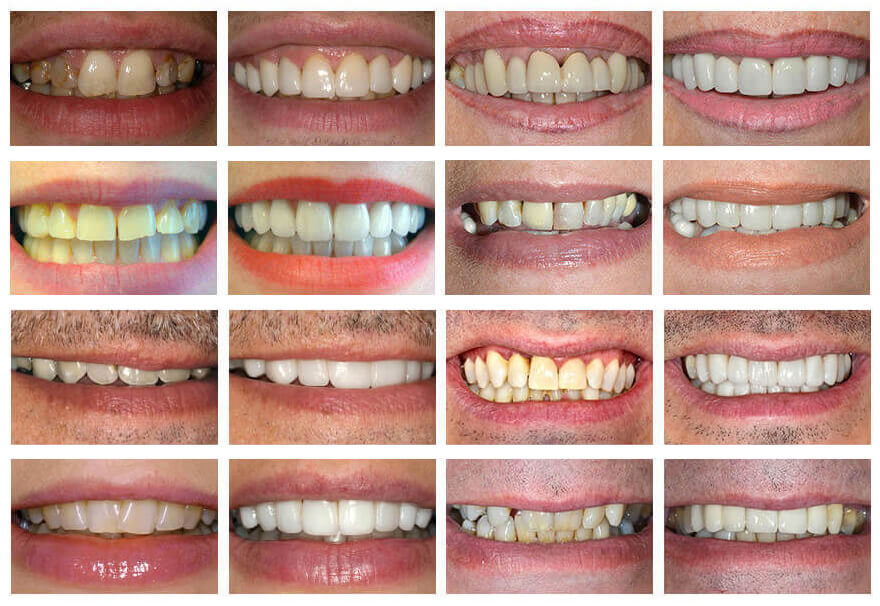 Teeth whitening kit